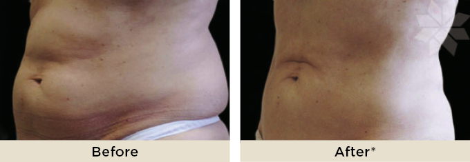 DrRakus_coolsculpting_beforeafter3.jpg