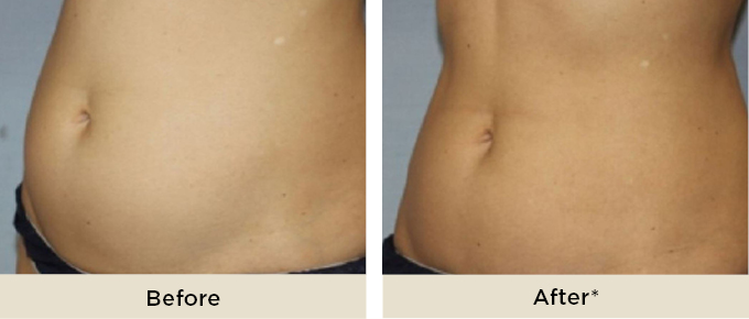 RR_lipocel_before_after2.jpg