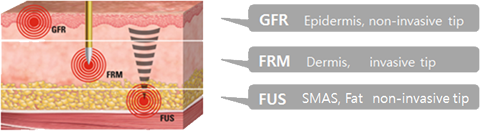 High Intensity Focused Ultrasound