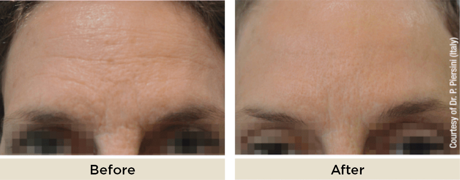 drritarakus_viscoderm_beforeafter3.jpg