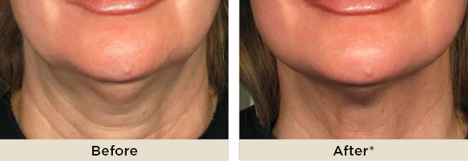 home_ritarakus_ultherapy.jpg