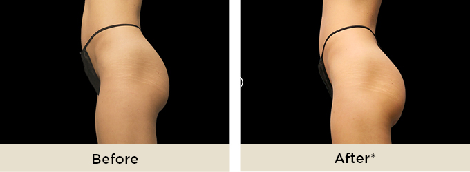 BTL EMsculpt | Fat Reduction Treatment | Dr Rita Rakus Knightsbridge