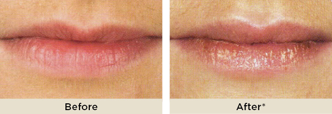 Dr Rita Rakus Lips Before After