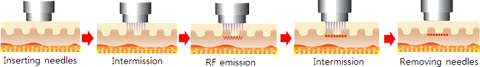 Fractional Radio Frequency Microneedling