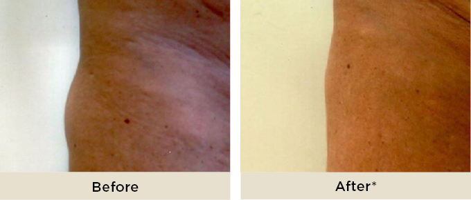 RR_lipocel_before_after3.jpg