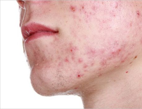 rr-acne.jpg